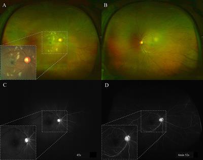 Purtscher-like retinopathy and paracentral acute middle maculopathy associated with improper antihypertensive drug use: a case report